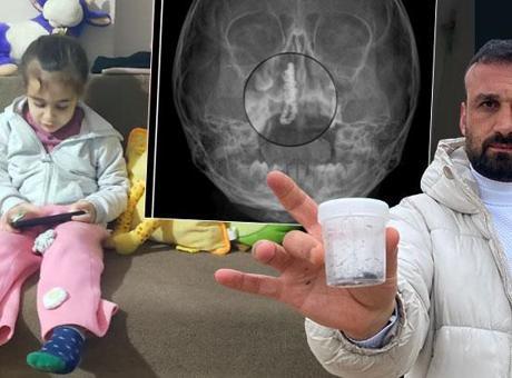 5 yaşındaki Polen, 2 yıldır burnunda taşıyordu! Akılalmaz olay: Nasıl görülmez?