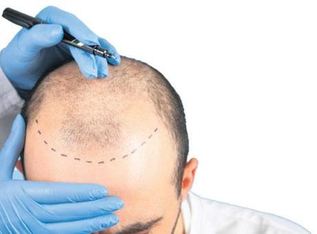 ‘Saç ekimi’ne vergi operasyonu