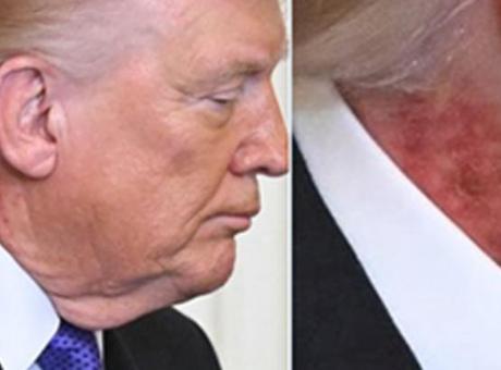 Trump’ın boynundaki kızarıklık hakkında doktorundan açıklama