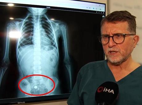 Parkta buldu, şeker diye yuttu! 4 yaşında çocuğu ölümden döndüren süreç röntgen filminde: Hareket halinde